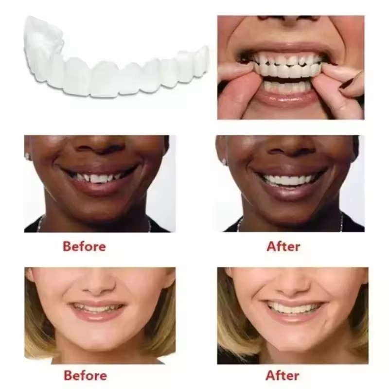 Veneer Gigi Pemutih Gigi Tirua - Teeth Whitening Veneers ulasan dan harga