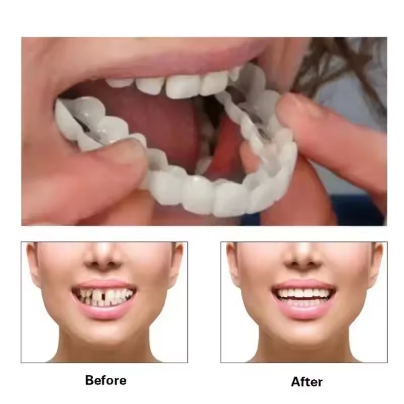 Veneer Gigi Pemutih Gigi Tirua - Teeth Whitening Veneers ulasan dan harga