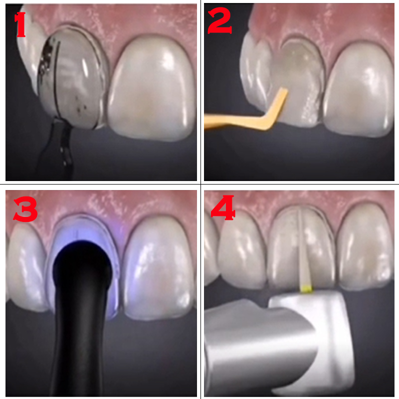 Cetakan Gigi untuk Veneer Resi - Teeth Whitening Veneers ulasan dan harga